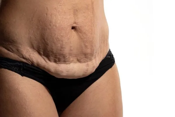 Lost the Weight but Not the Loose Skin? 1 image of womans stomach after weight loss showing loose skin Warwick